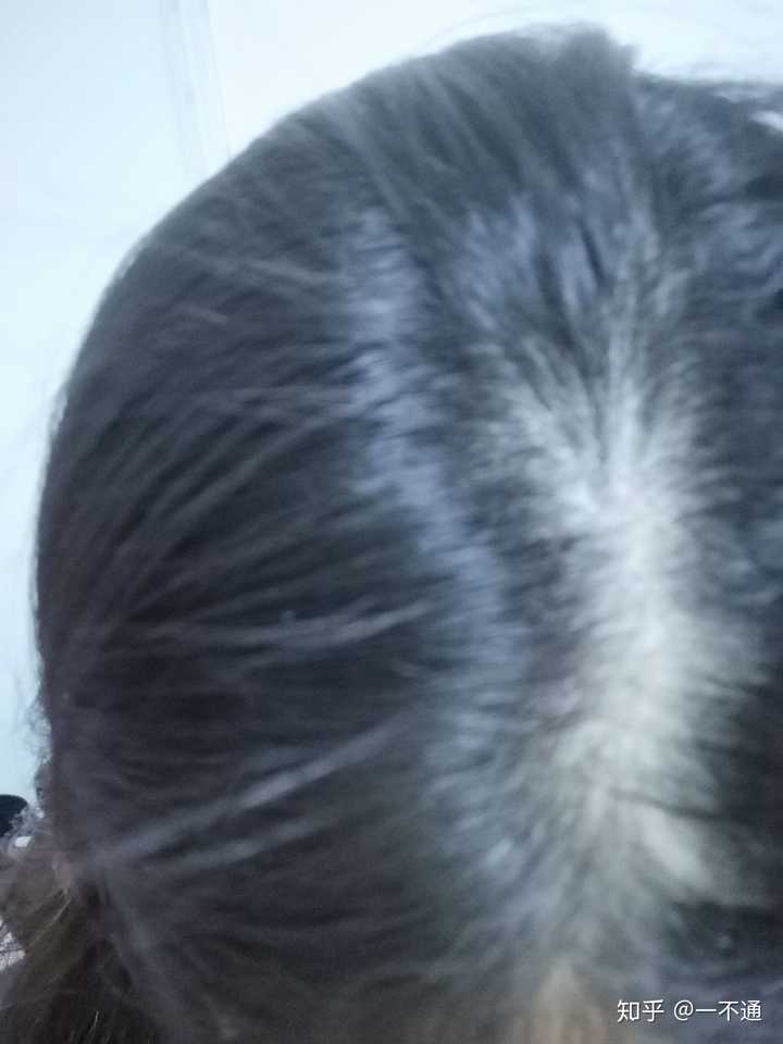 女生秃顶是怎样一种体验?
