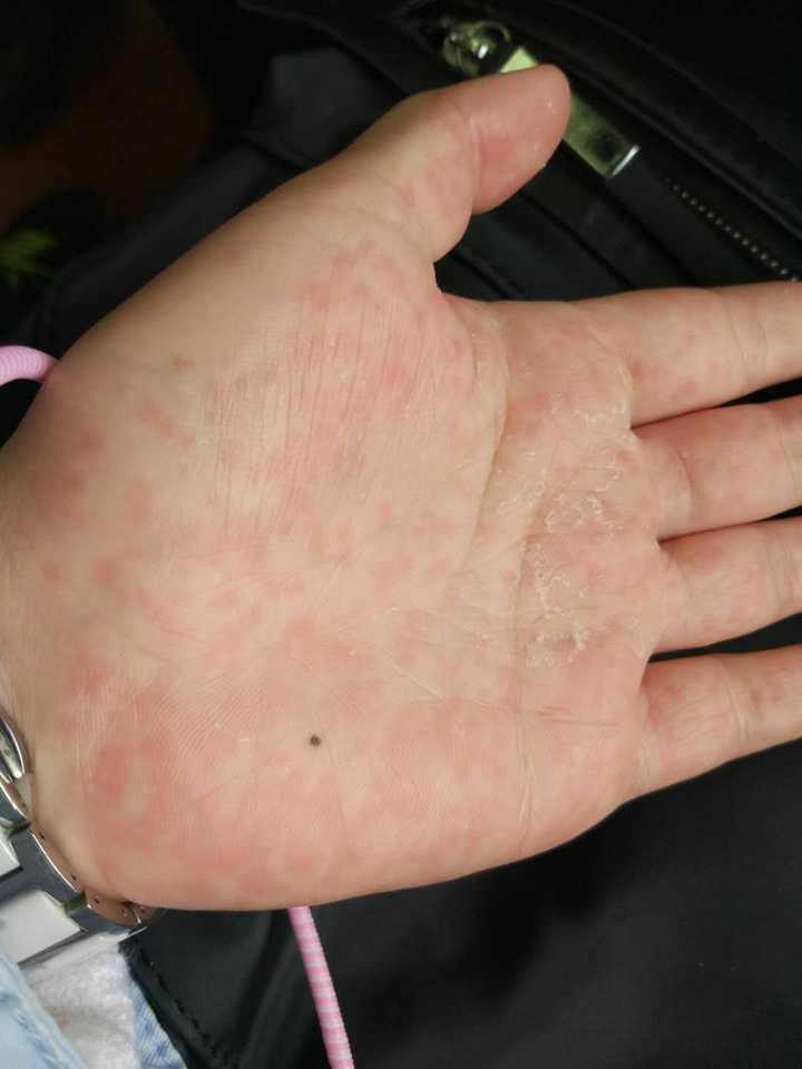 一到秋冬季节手上就起小红疹,又痒又刺痛,手指侧面还有小水泡,怎么办?