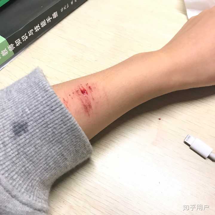 人为什么会自残?