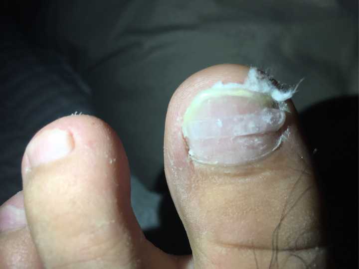 嵌甲怎么治?通过修脚的方式能治好吗?