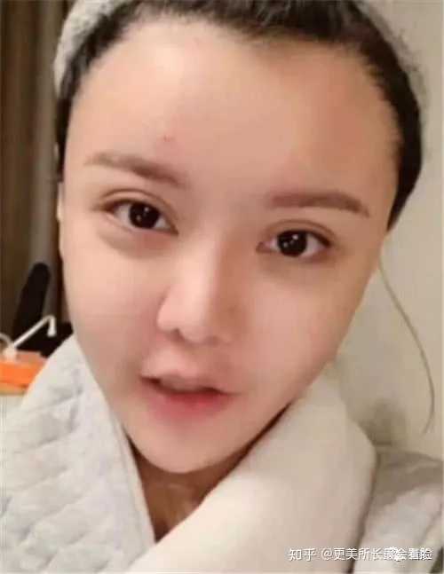 割双眼皮要多久恢复自然?