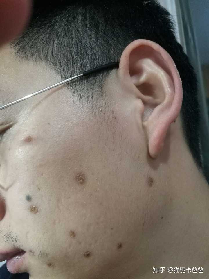 激光点痣祛痣祛斑是什么体验?