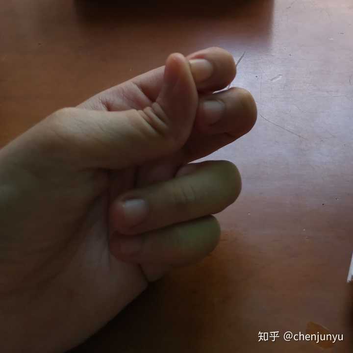 手指十个指头第一关节可反向弯曲90度正常吗?