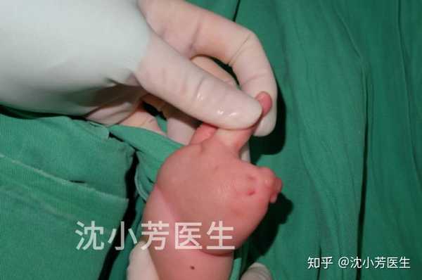 束带综合征
