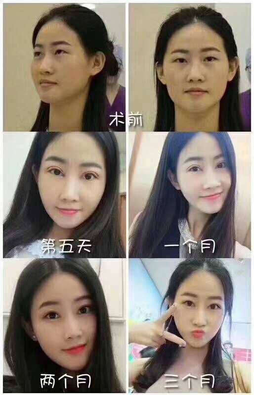 来看看双眼皮的威力,单眼皮肿眼泡去掉后立刻仙起来,想变美要抓紧行动