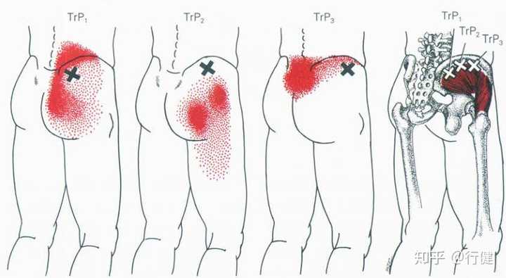 骨稳定腰椎的关系,下面来讲讲臀中小肌损伤会直接造成腰腿痛,而且造成