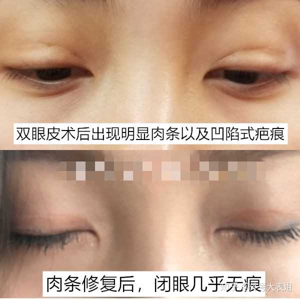 割双眼皮呈现肉条是什么因素?