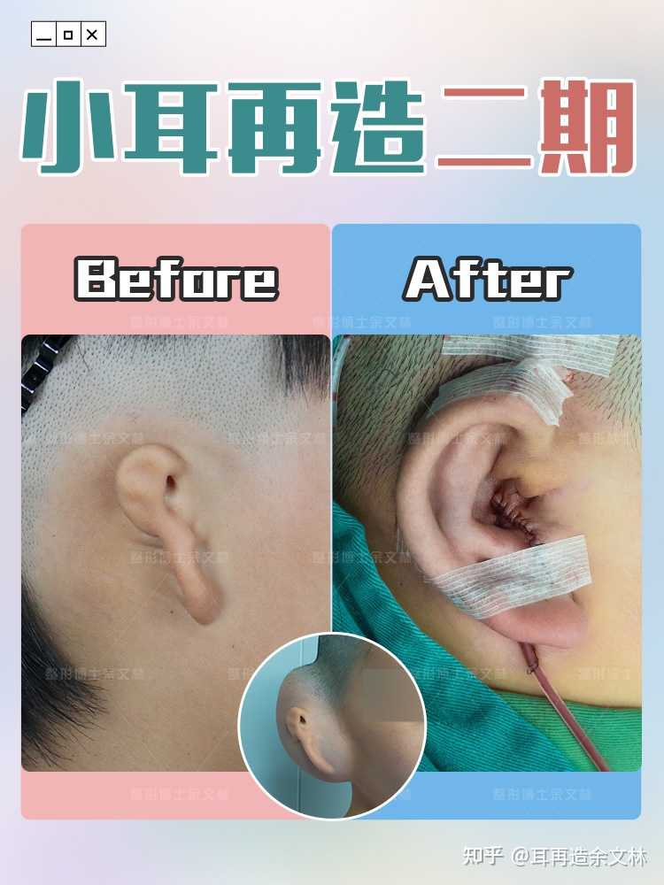 右侧耳朵小耳畸形修复