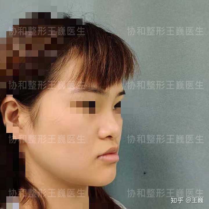 月亮脸,面中凹陷,下巴突出,很丑很自卑,请问正颌手术能改变我的脸型吗