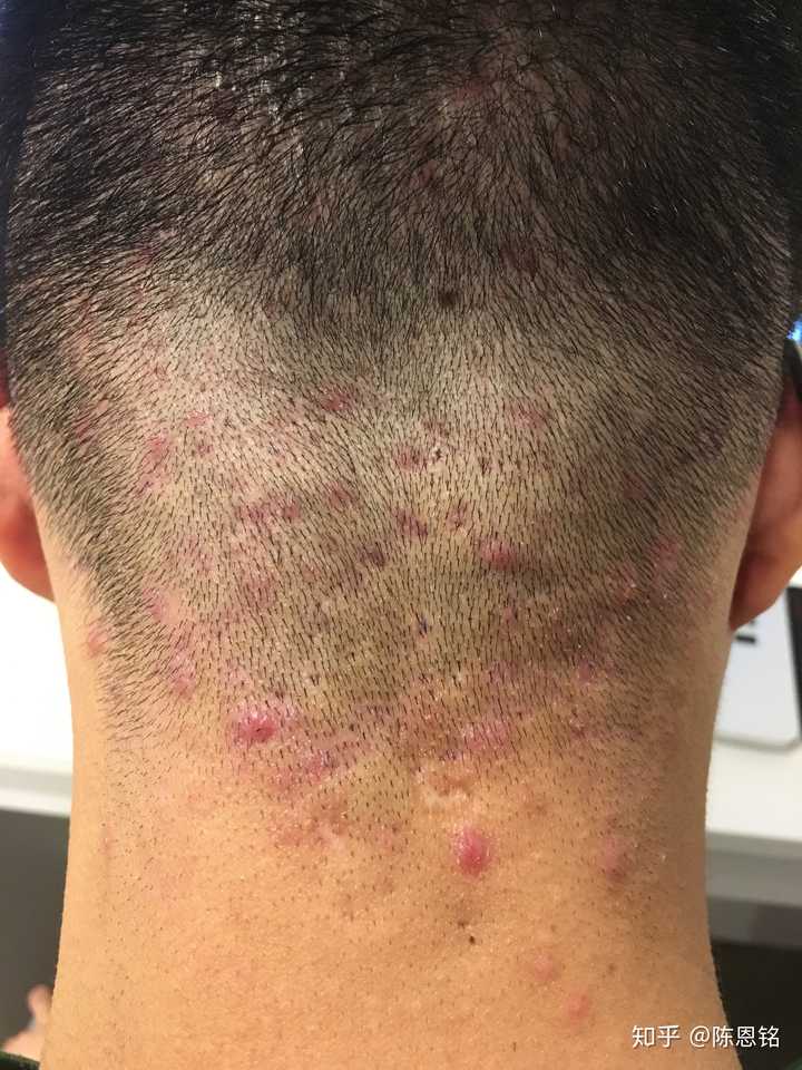 脖子后面头发里长很多痘痘?
