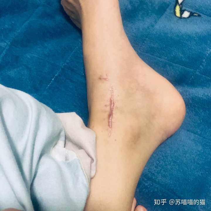 脚骨折,行动不便是个什么体验?