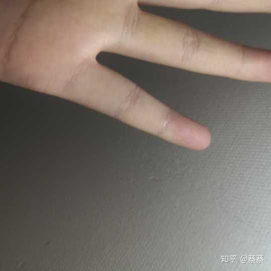 现在一点痕迹都没有啦