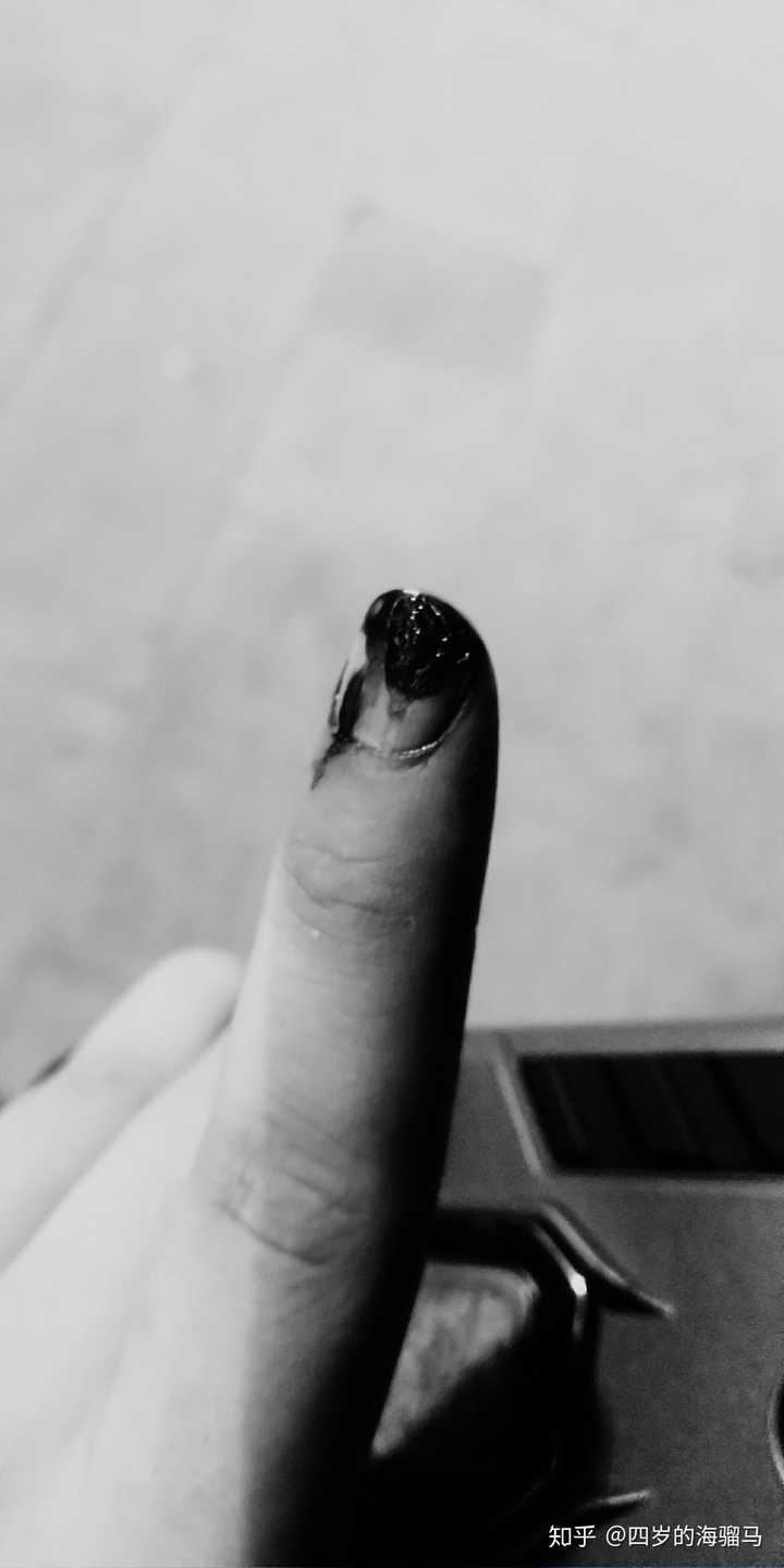 切菜的时候把手指甲切掉了一半血流不止,英国的医生只