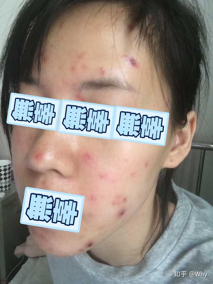 前三四天断断续续都持续发烧中 最早出来的水痘已经准备干涸正在向着