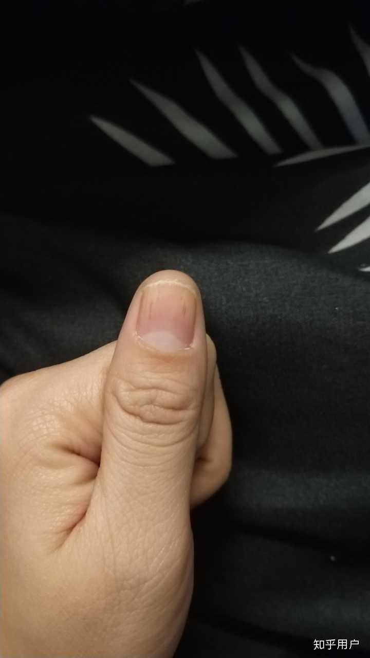 怎样治疗灰指甲?