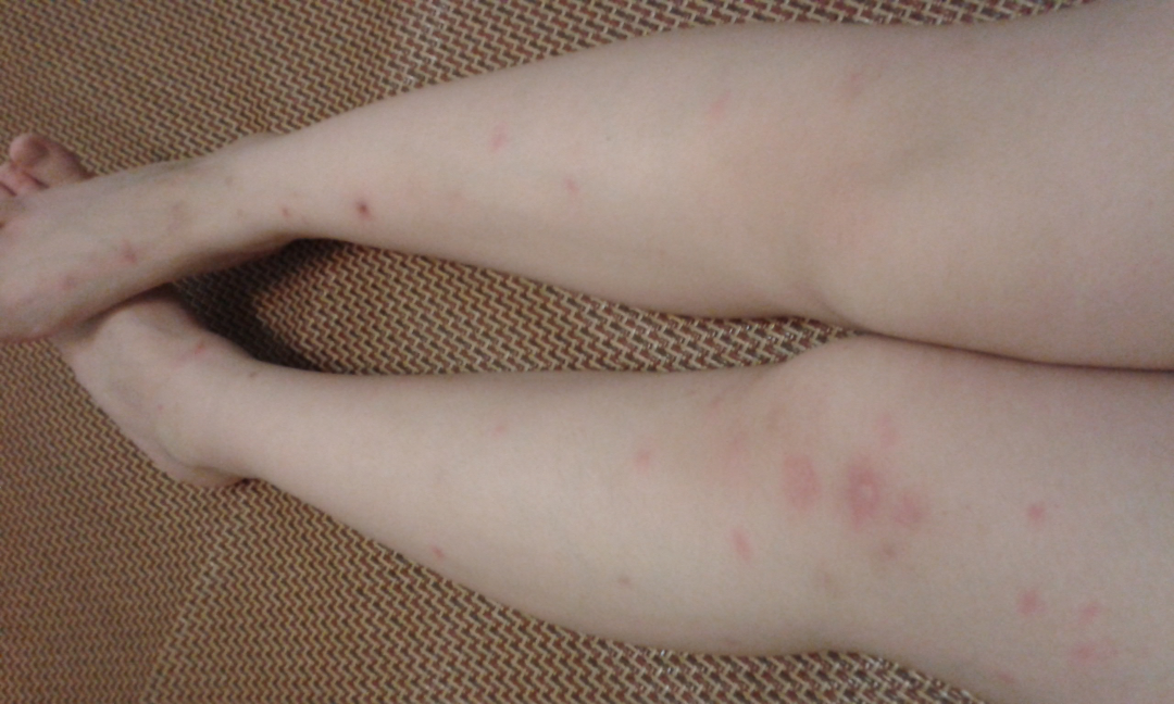 我的腿被蚊子咬得体无完肤(带图),怎样有效地消除蚊子