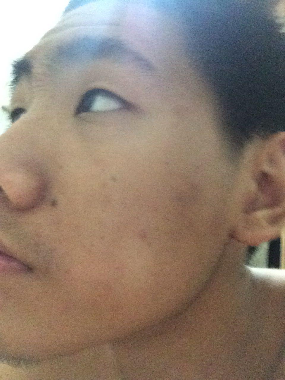 脸上痘痘和痘印怎么调养。? - 青春痘治疗 - 知