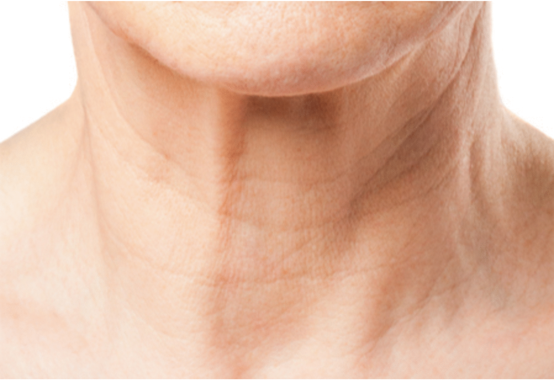 重力会使皮肤下垂或者产生褶皱,比如双下颌,颈部皱纹.