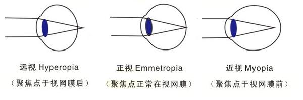 儿童如何预防近视?