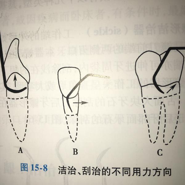 牙周炎治疗的龈下刮治和普通洗牙有何异同?