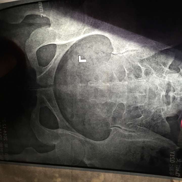 尾骨摔了,到骨科医院拍片检查,医生说尾骨撞凹进去了