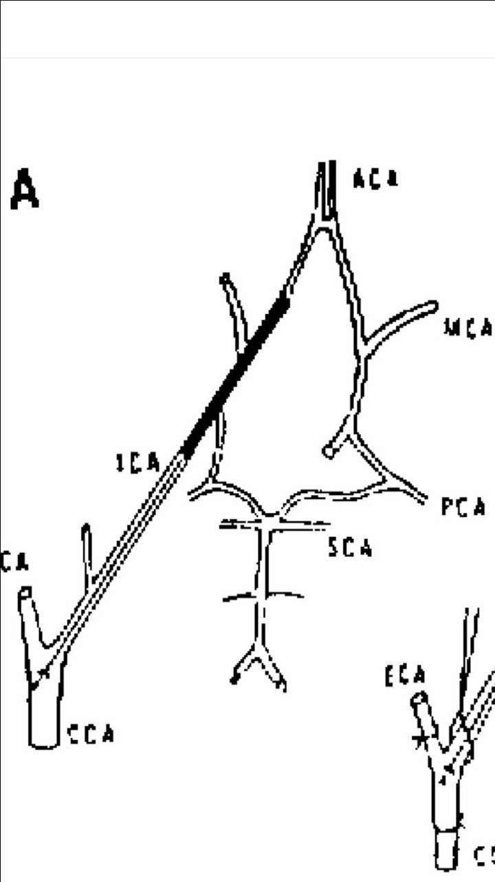 大鼠脑内有一个动脉环(见下图),当结扎掉一个颈总动脉的时候,另一侧