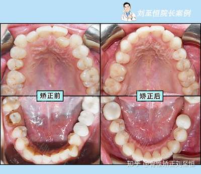 由于牙齿拥挤不易自洁而引发龋病及牙龈牙周炎症,可见局部牙龈红肿
