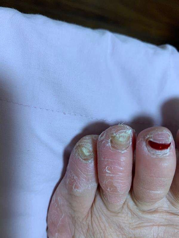 其实灰指甲是真菌感染形成 做好除菌和修复就能治.