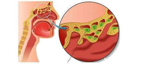 有没有哪位大神能够分享治疗鼻窦炎的方法