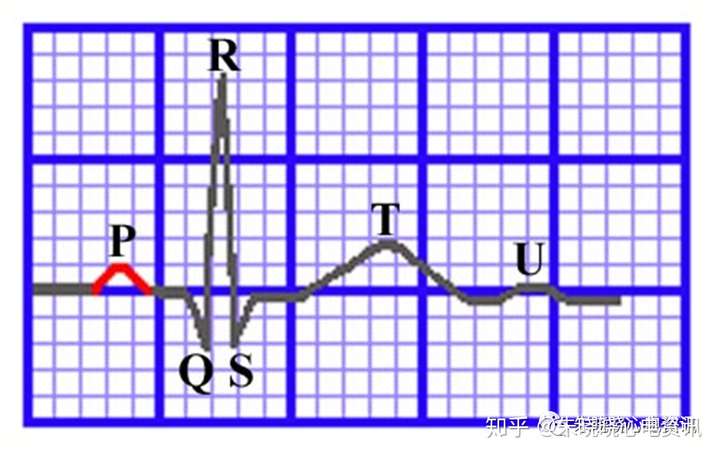 心电图各波段的命名和定义你掌握了吗