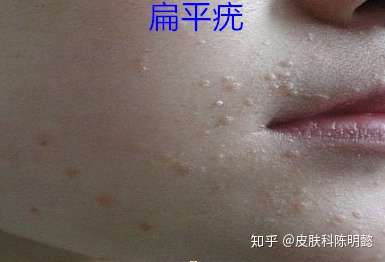 扁平疣是痔疮吗