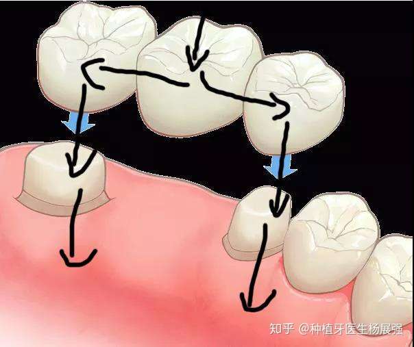 镶牙