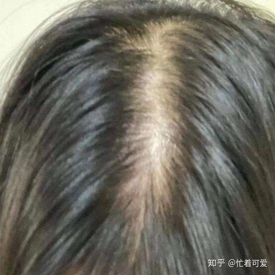 先给你们看一下我脱发前后的对比图.