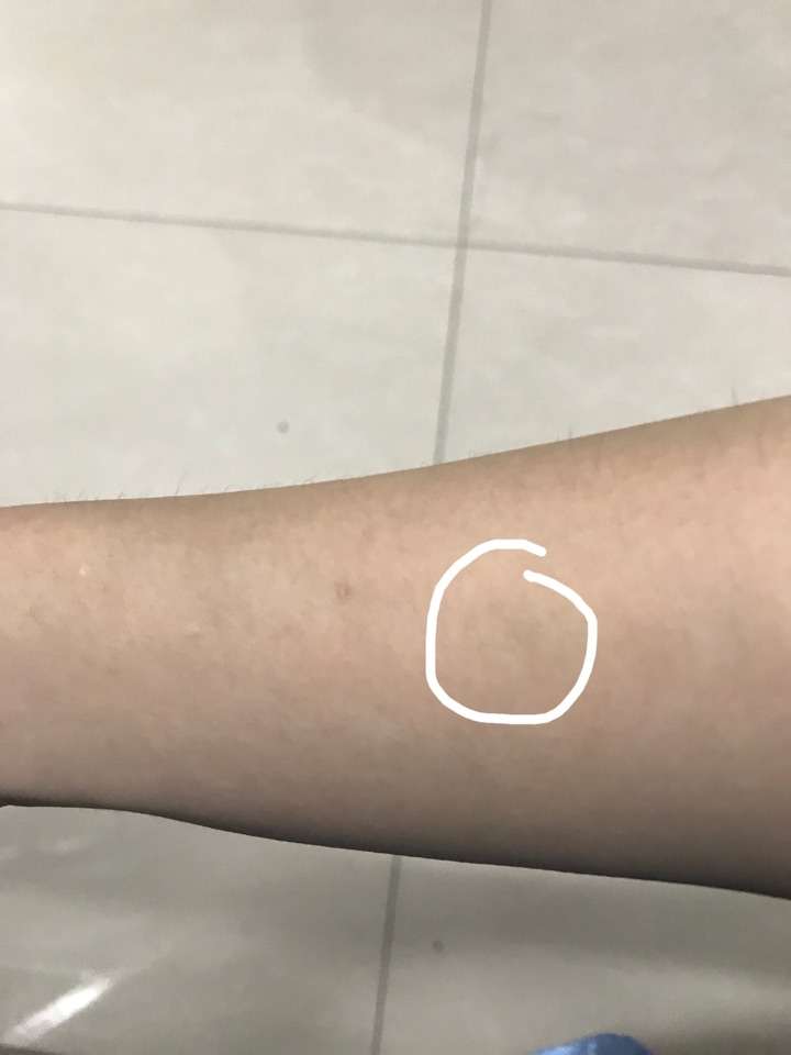 输液使用留置针后针眼处的皮下有包块怎么办?