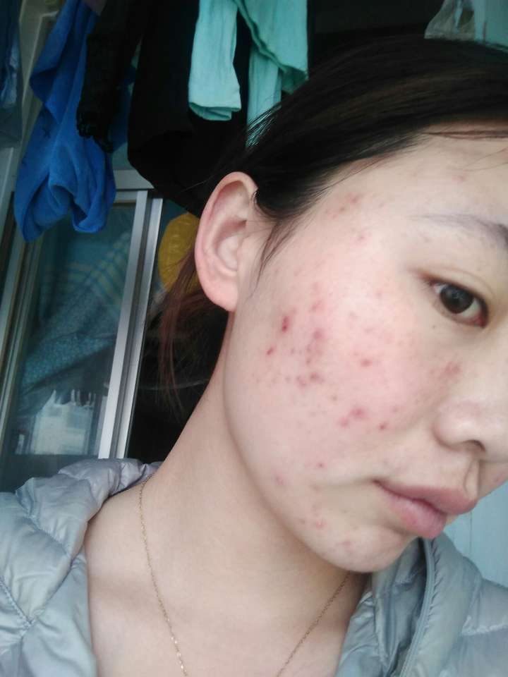 青春期长痘痘自卑,不想与别人交流怎么办?