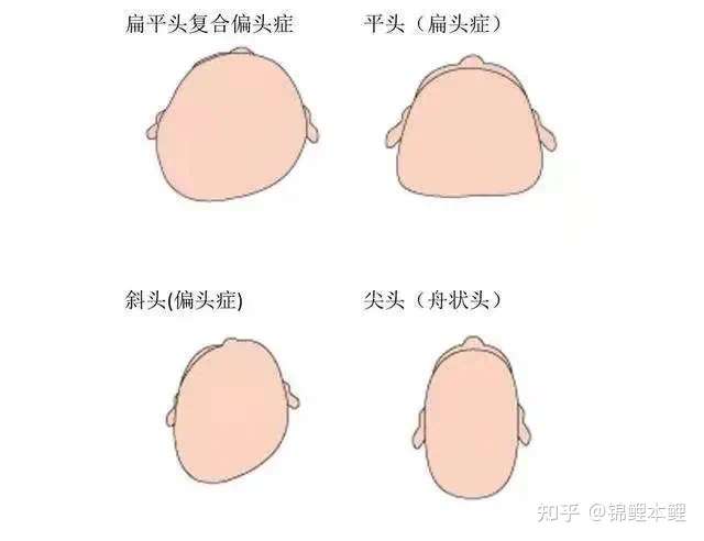 宝妈们知道宝宝头型睡偏该怎么纠正吗?