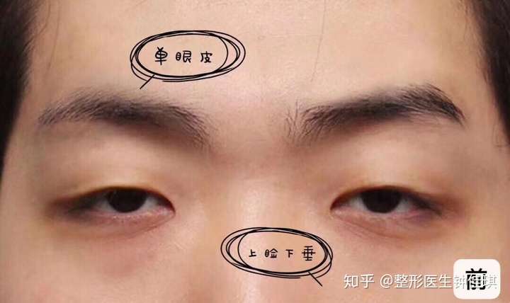 一边眼睛有神一边无神怎么办?