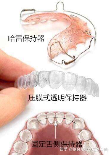 2年整牙经验分享关于佩戴保持器的那些事