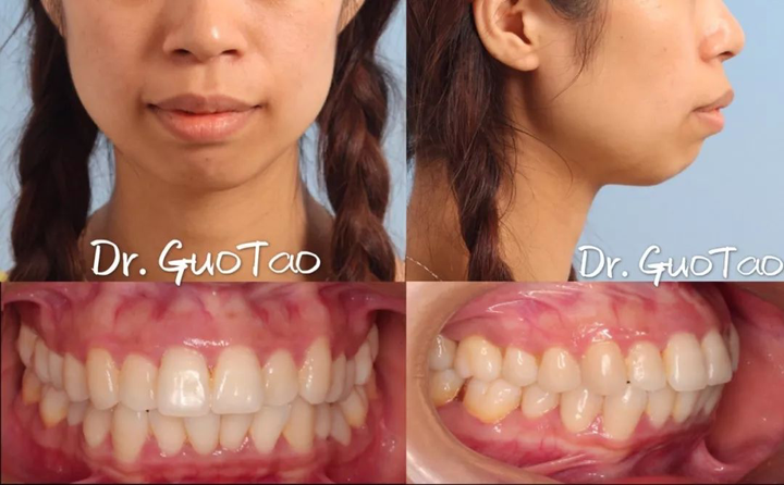 患者牙齿较为整齐,但闭唇状态下,口周紧张,侧面看起来没有下巴