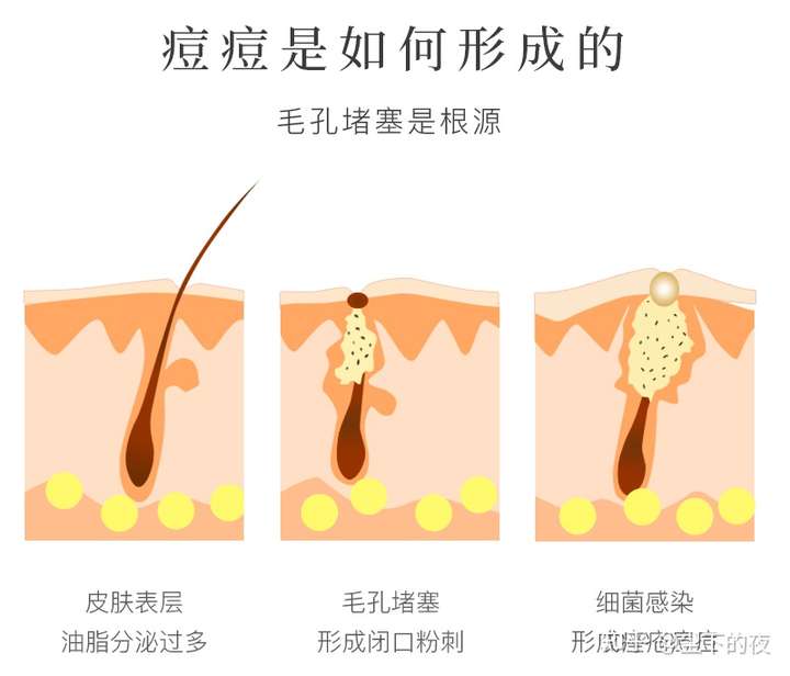 要知道的是,痘痘形成原因大多都是:【油脂分泌过多】【毛孔堵塞】