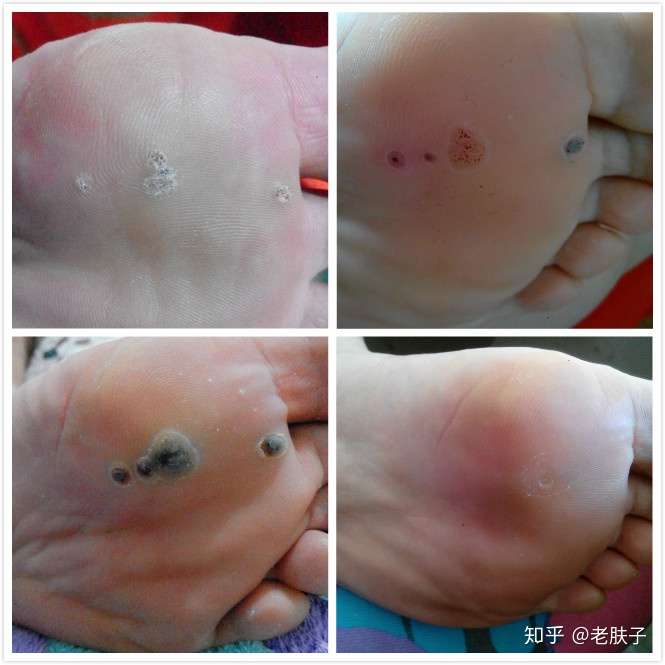 脚上长了疣还是什么?