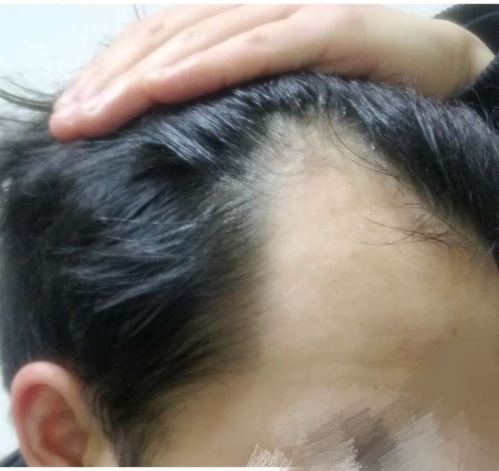 秃顶怎么办?