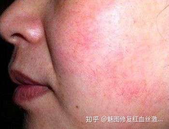 红血丝皮肤也有敏感肌肤肤质的特点,就是都容易受到外界刺激和伤害