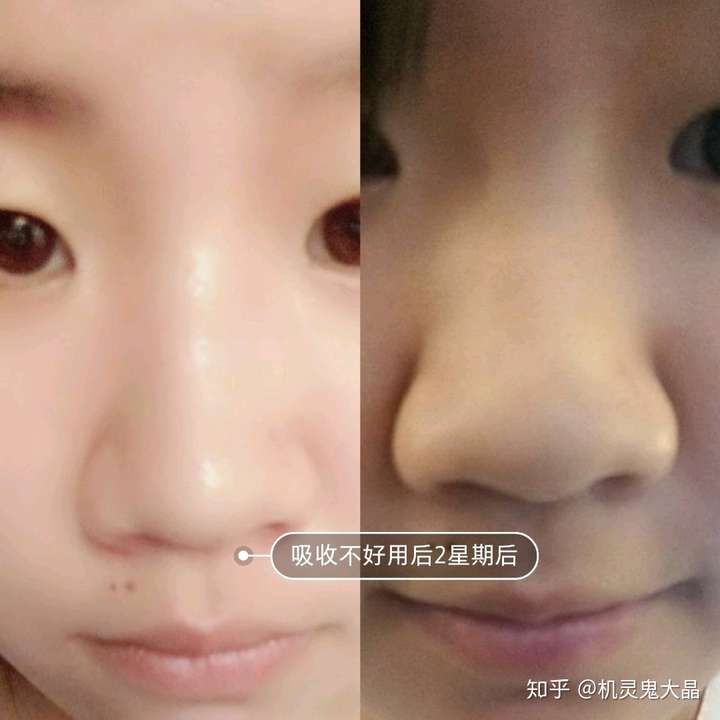 鼻子大真的很难看吗?