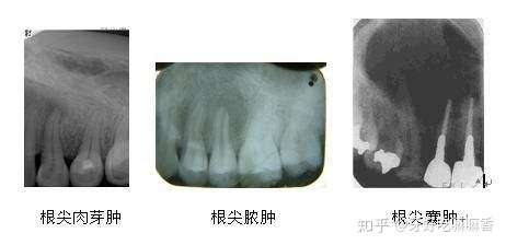 牙洞是什么为什么会出现牙洞