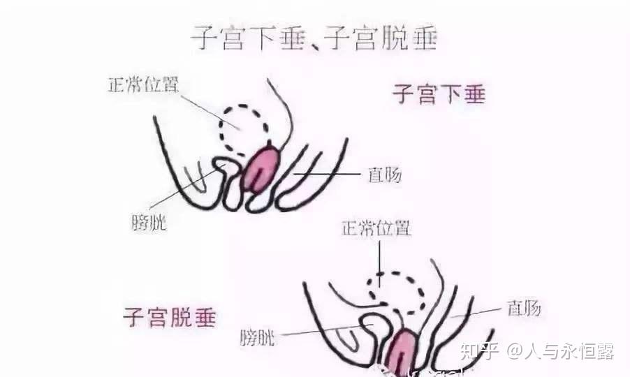 甚至子宫全部脱出于阴道口以外,常合并有阴道前壁和后壁膨出