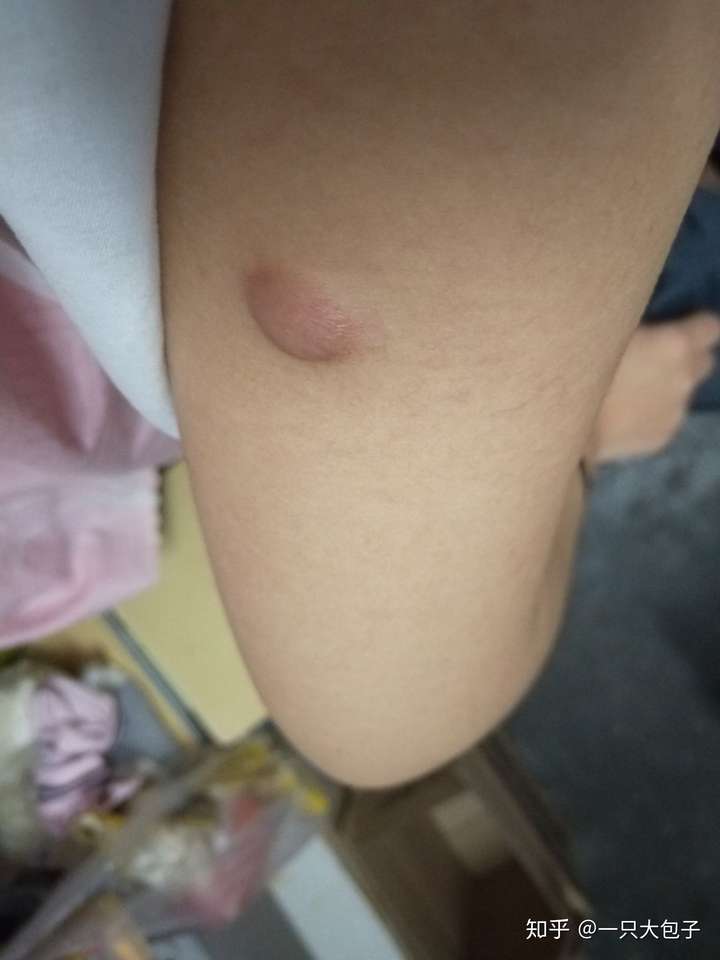 有谁知道身上和胳膊上肉里面硬硬的圆疙瘩小拇指头那么大的东西是什么