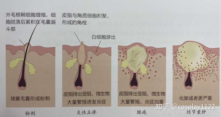 脸上长粉刺痘痘怎么办?