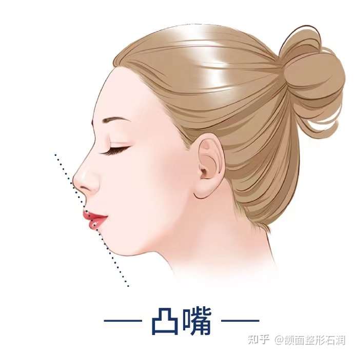怎么确定是下巴后缩还是下颌后缩