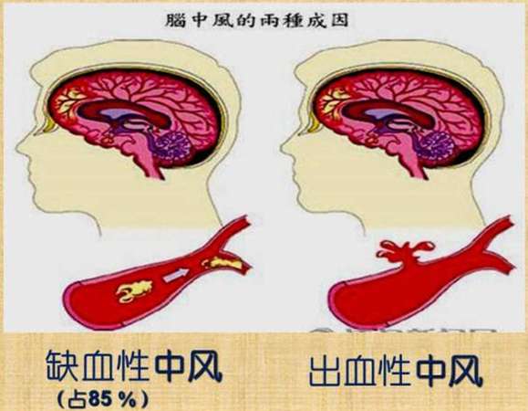 高发重疾:为何脑中风180天后才能理赔?